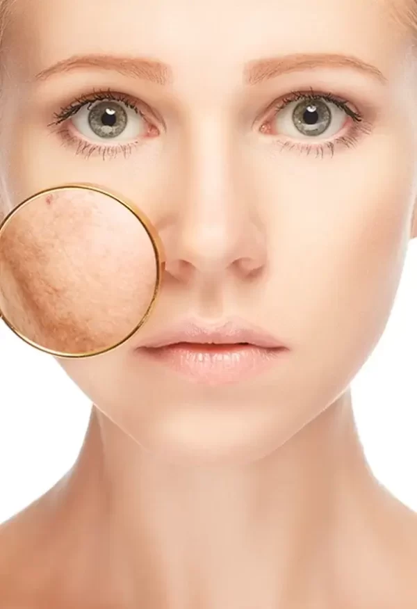 Pigmentation Melasma Treatment Durban